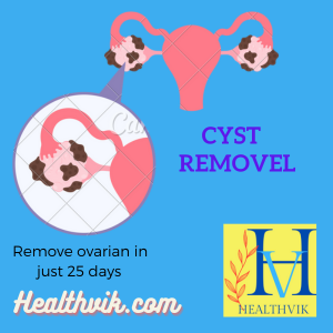 cyst remove