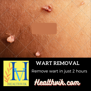 wart remover