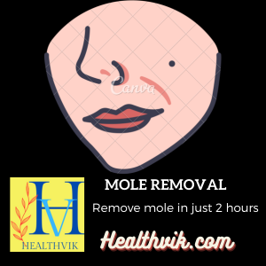 Mole remover